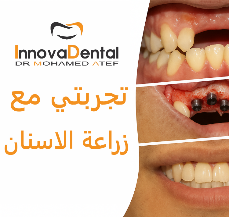 My experience with dental implants